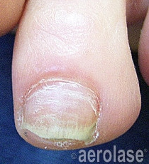 Fungal Nails Removal in South Bay Los Angeles | Spade Skincare