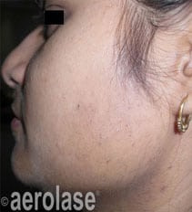 Laser Hair Removal Services in South Bay Los Angeles | Spade Skin Care