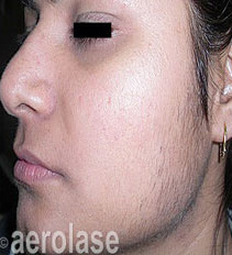 Laser Hair Removal Services in South Bay Los Angeles | Spade Skin Care