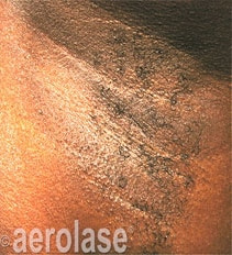 Laser Hair Removal Services in South Bay Los Angeles | Spade Skin Care