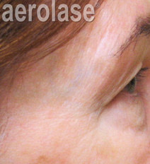 Rejuvenation 2 AFTER