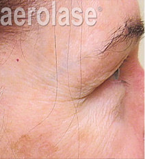 Rejuvenation 2 BEFORE