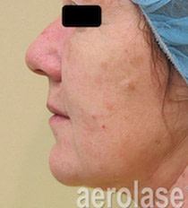 Rejuvenation 3 AFTER