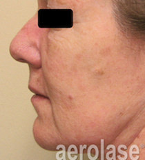 Rejuvenation 3 BEFORE