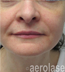 Rejuvenation 4 AFTER