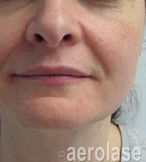 Rejuvenation 4 BEFORE