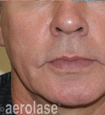 Rejuvenation 5 AFTER