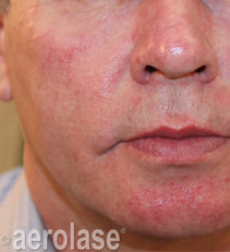 Rejuvenation 5 BEFORE