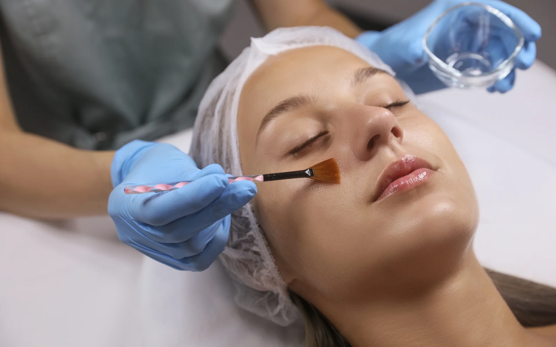 chemical vs microneedling peel for acne scars