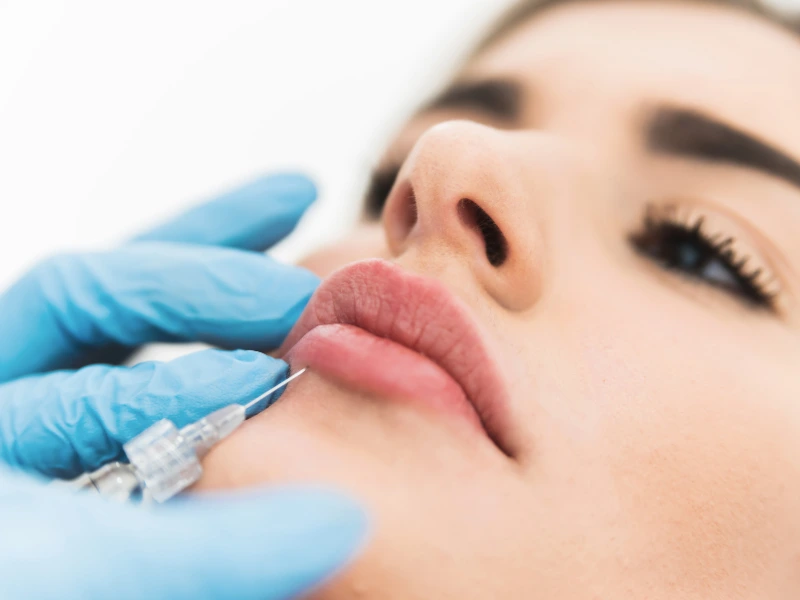 Lip Fillers Treatment Process