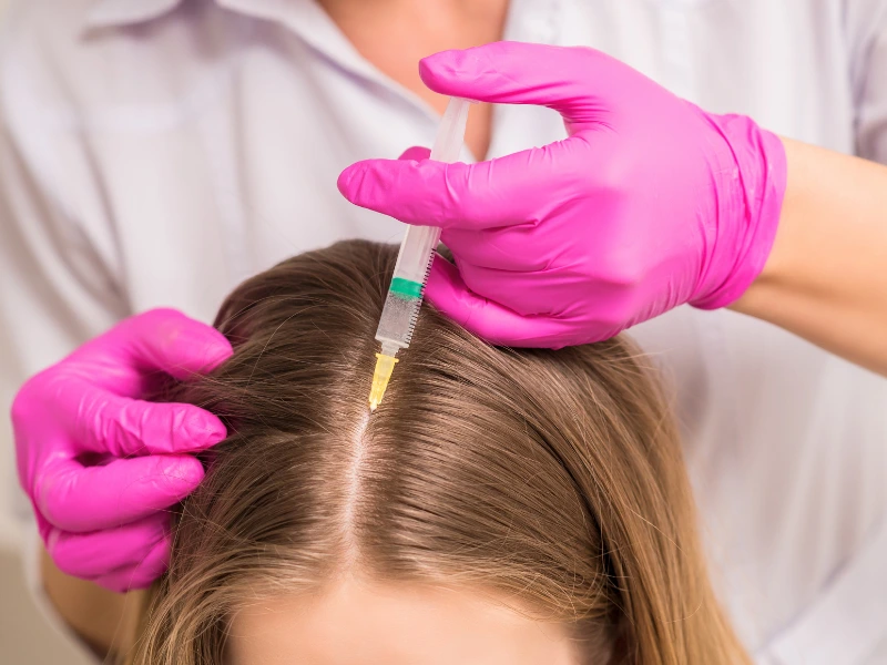 Process of Exosome Hair Injections