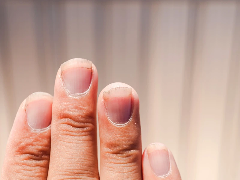 laser fungal nail treatment cost