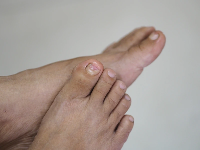 laser fungal nail treatment reviews