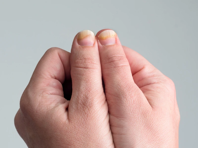 laser fungal nail treatment