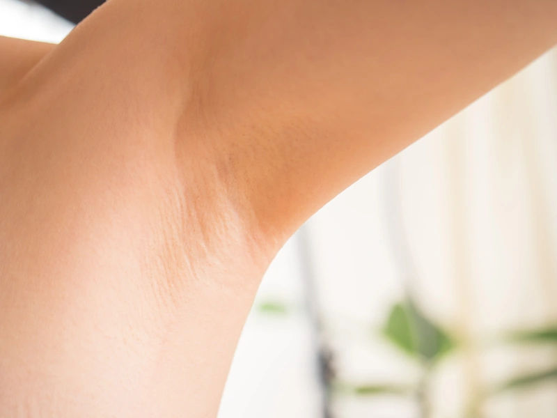 laser hair removal before and after