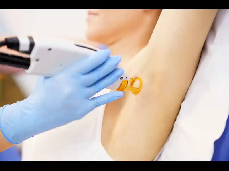 laser hair removal
