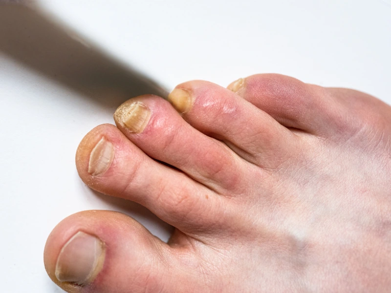 stubborn toenail fungus