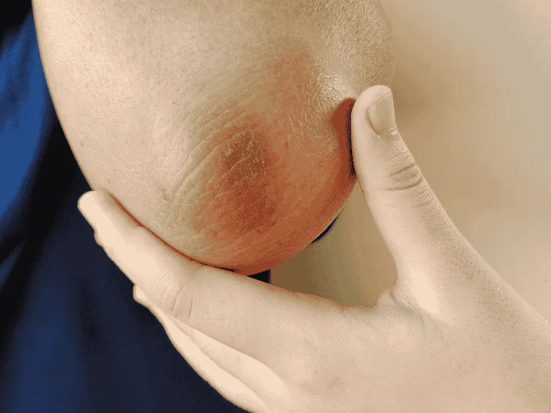 what is elbow bleaching