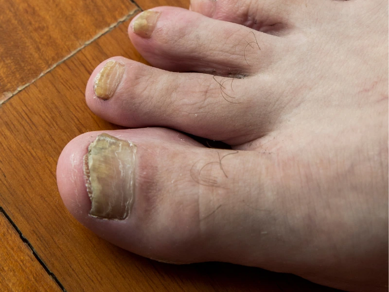 what is laser fungal nail treatment