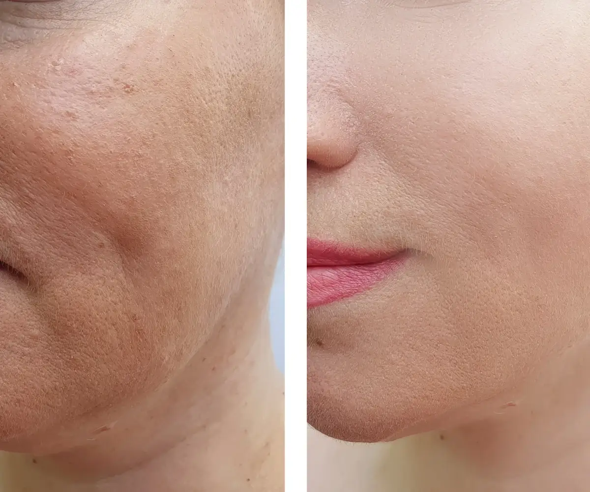 ipl photofacial before after