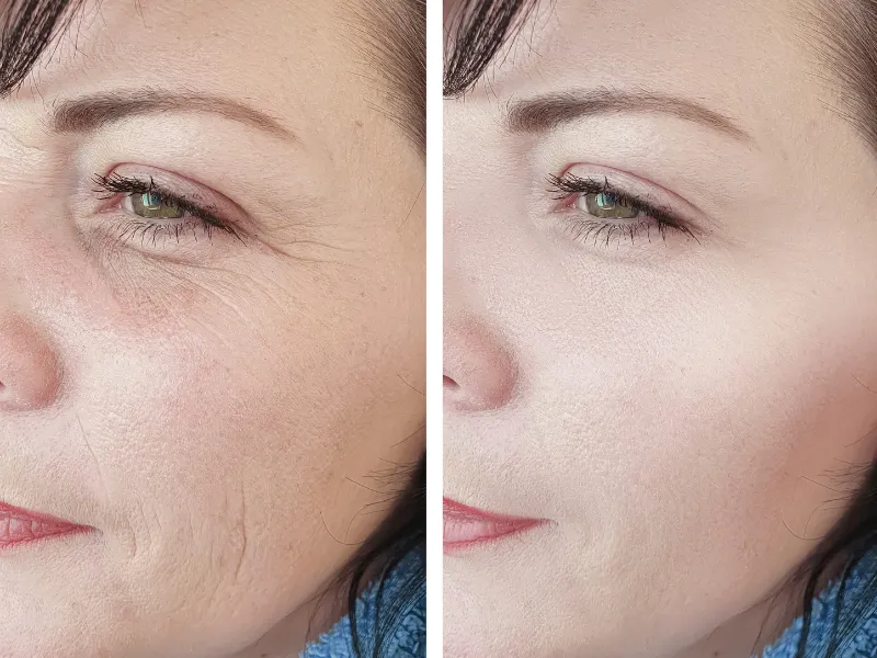 juvederm treatment before and after