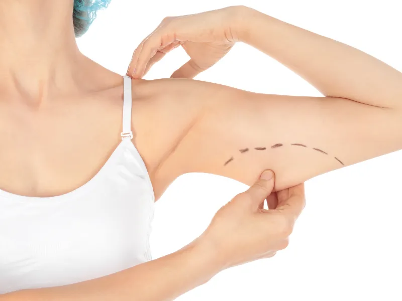 what is arm lift treatment