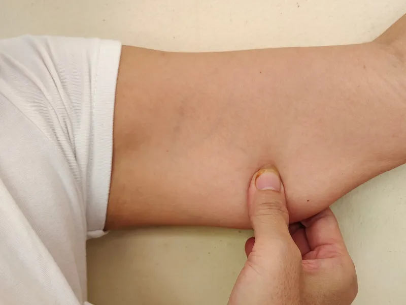 what is non surgical arm lifitng