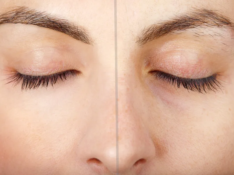laser eyebrow tattoo removal before and after