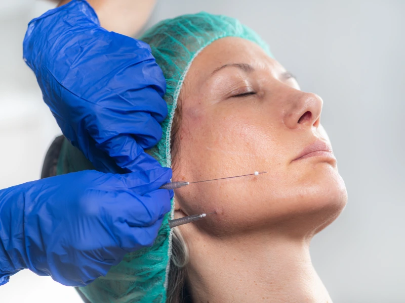 pdo thread lift and Its function