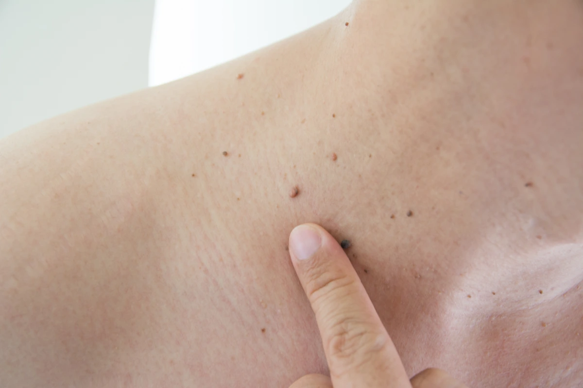 skin tag removal redondo beach