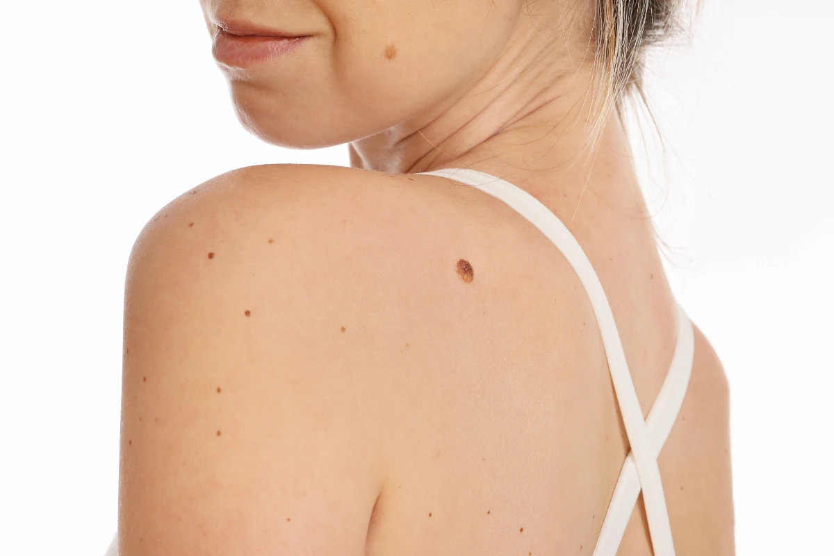 treatment to remove skin tags