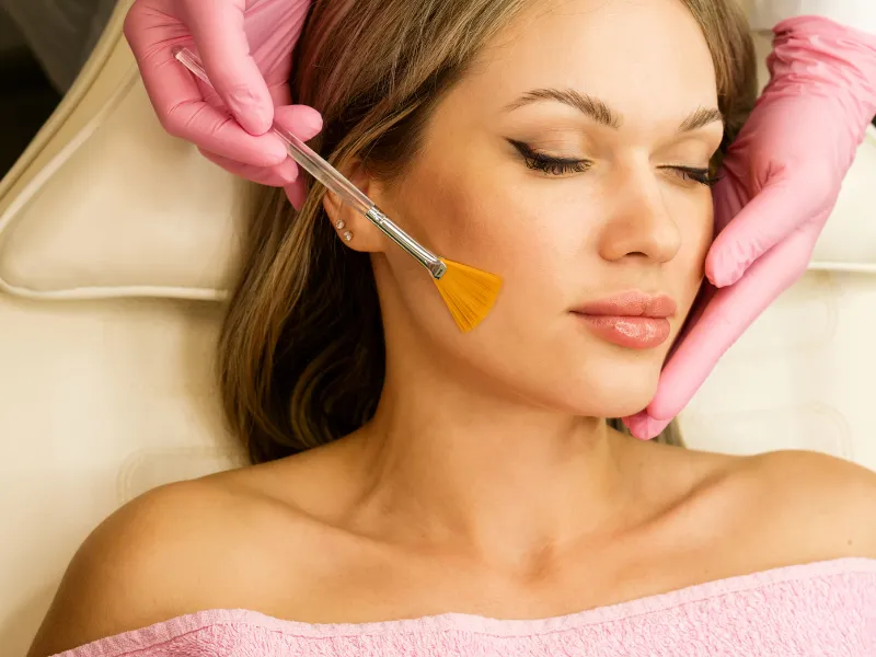 vi peel in redondo beach