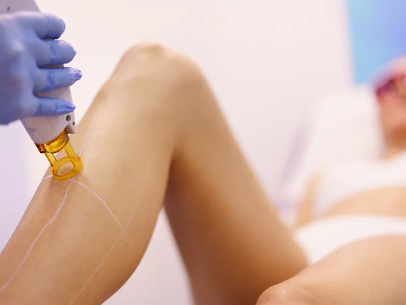 what are laser hair removal legs