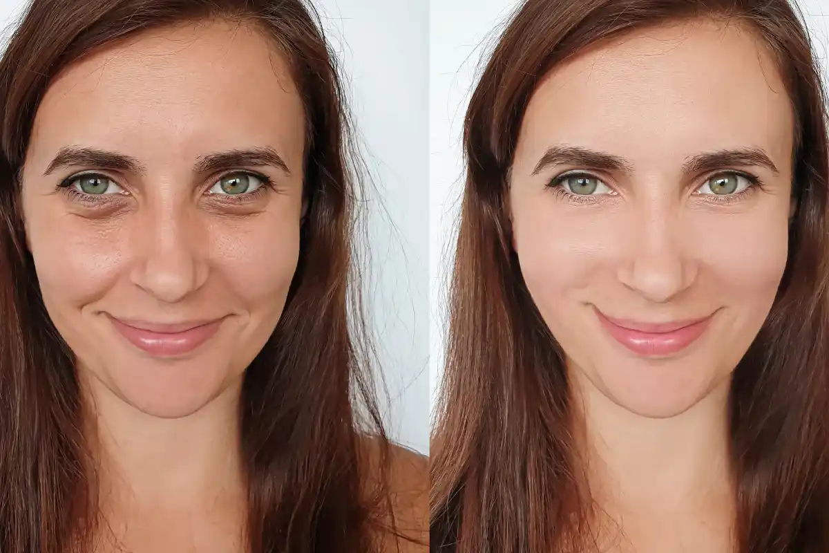 restylane before and after