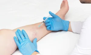 what to avoid after sclerotherapy