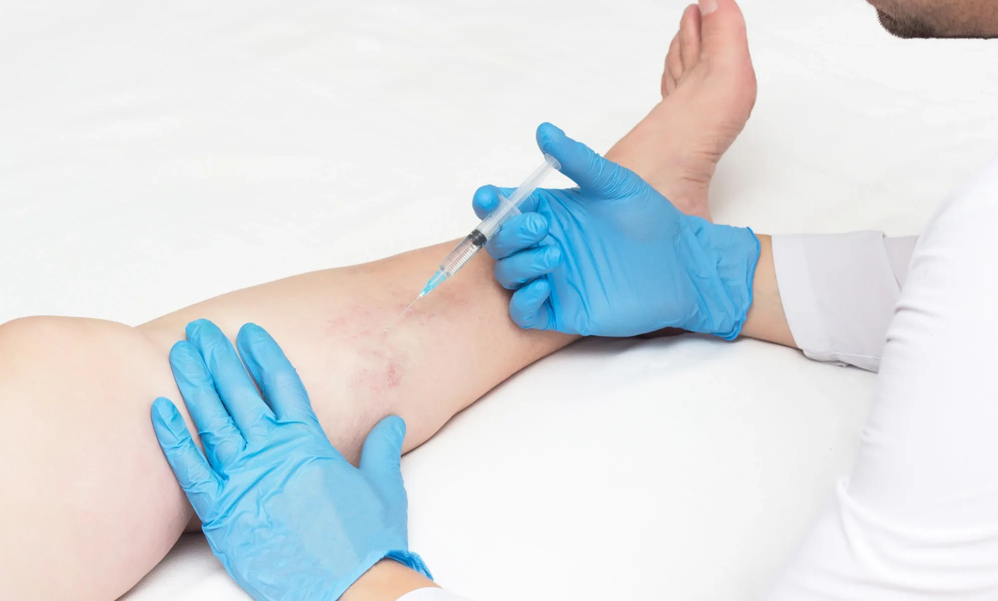 what to avoid after sclerotherapy