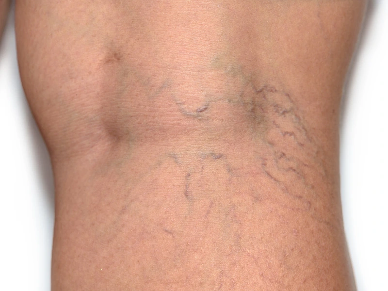 cost of sclerotherapy for spider veins