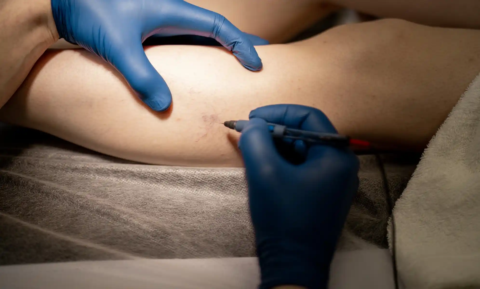 how much does sclerotherapy cost