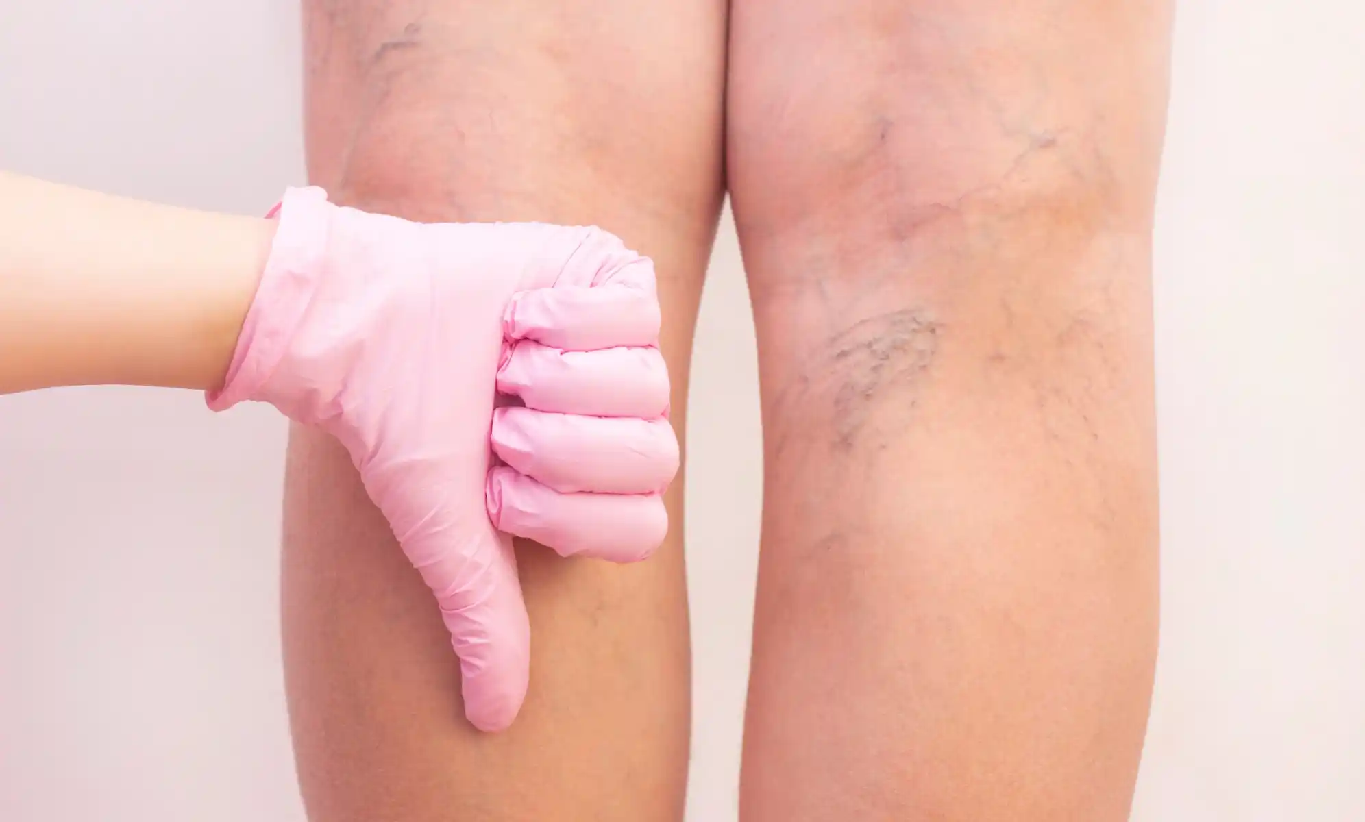 how much does spider vein treatment cost