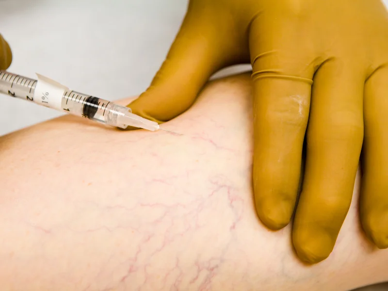 right spider Vein treatment