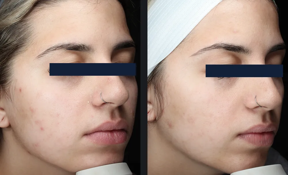 before-and-after-hydrodermabrasion-facial.webp