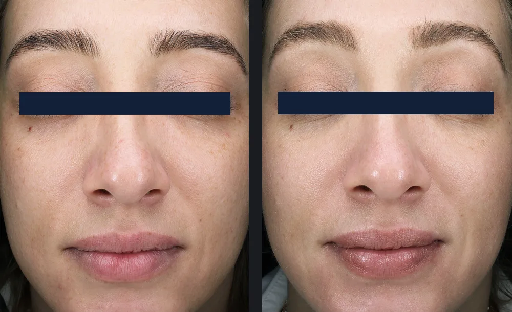 hydrodermabrasion-facial-before-after-results.webp