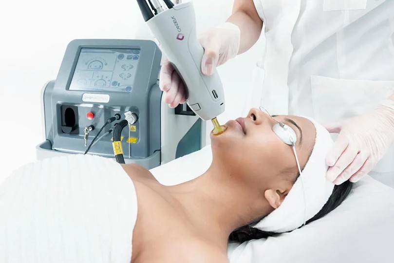 Laser hair removal in Los Angeles using advanced medical-grade laser technology