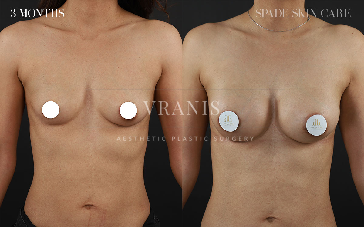 Sugical-Gallery-Breast-&-Chest-Enhancement-1