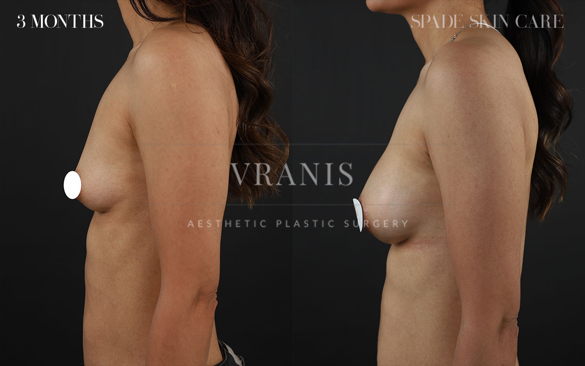 Sugical-Gallery-Breast-&-Chest-Enhancement-2