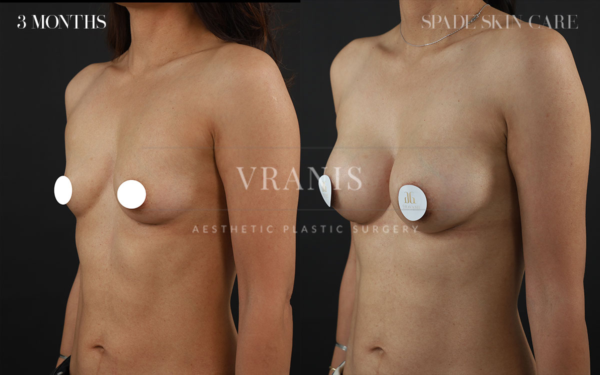 Sugical-Gallery-Breast-&-Chest-Enhancement-3