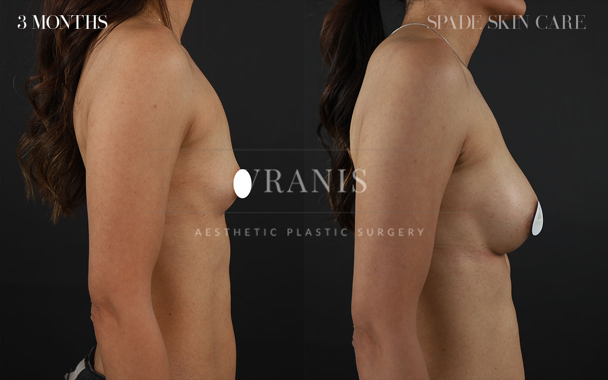 Sugical-Gallery-Breast-&-Chest-Enhancement-4