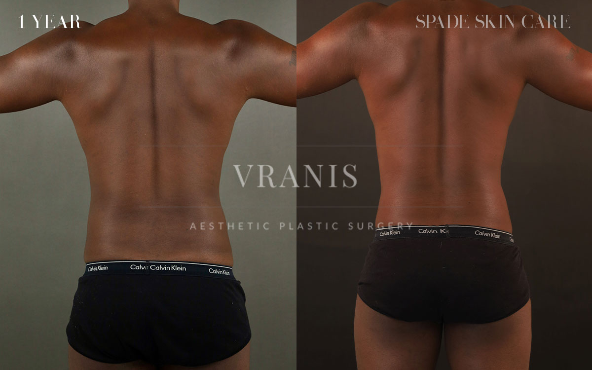 Sugical-Gallery-Midsection-Contouring-1