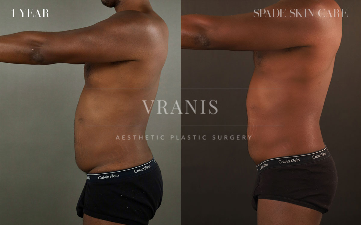 Sugical-Gallery-Midsection-Contouring-3