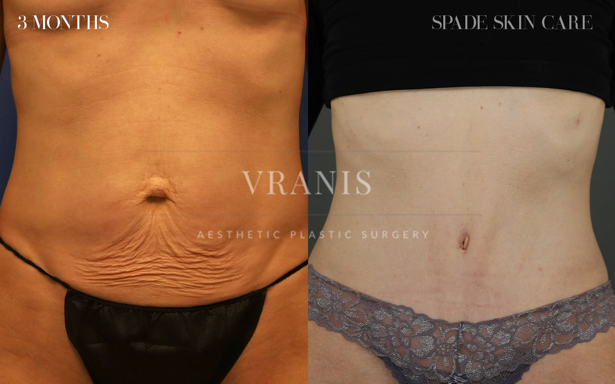 Sugical-Gallery-Midsection-Contouring-4